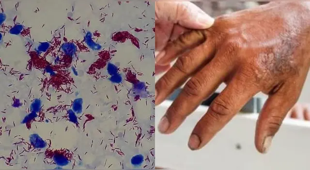 La lepra es una de las enfermedades que azotó a la humanidad desde la Edad Media. La lepra es una de las enfermedades que azotó a la humanidad desde la Edad Media.