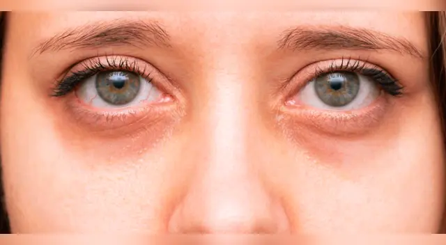 ¿Cuántos tipos de ojeras existen?