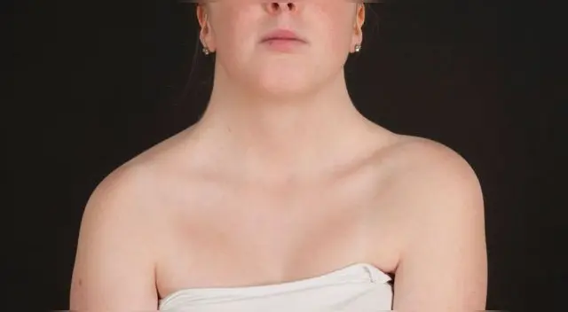 Día Mundial contra el Síndrome de Turner: Conoce qué es y las complicaciones que genera