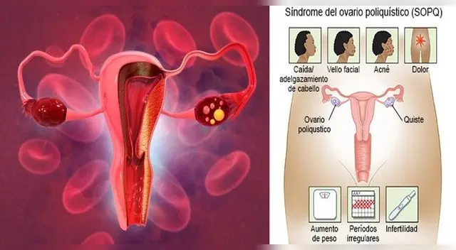 Los ovarios poliquísticos son comunes en la edad reproductiva.