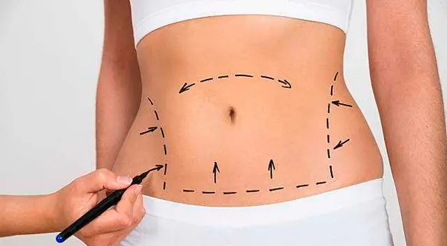 Toma en cuenta estas consideraciones para realizarte la lipoescultura. Toma en cuenta estas consideraciones para realizarte la lipoescultura.