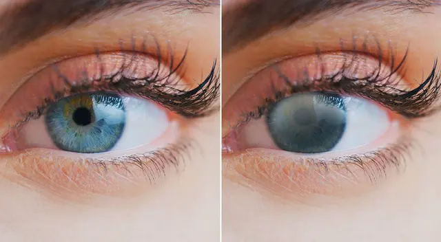 Catarata se mantiene como mayor causa de ceguera en el país, pese a que es reversible. Catarata se mantiene como mayor causa de ceguera en el país, pese a que es reversible.