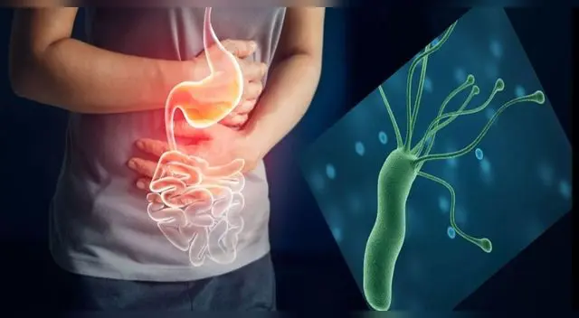 Comer una dieta blanda es la mejor opción para contrarrestar la bacteria.