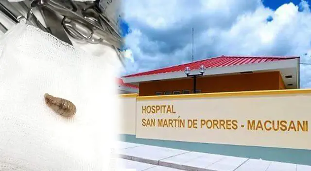 Encuentran gusano vivo en cuerpo de una gestante y lo extraen en hospital de Puno.
