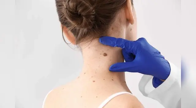 Si tienes un lunar que cambia de color, tamaño o forma, acude a un médico.