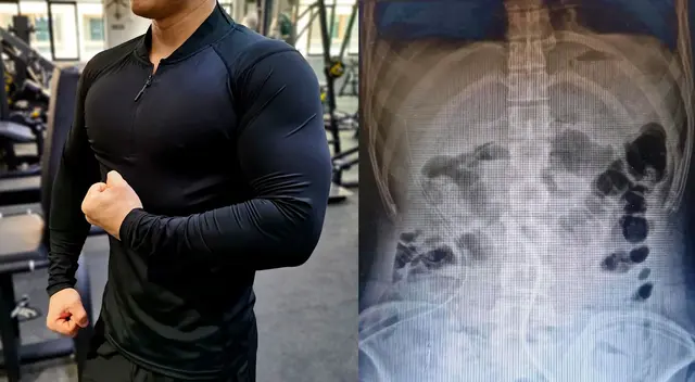 El joven de 26 años llegó de emergencia al hospital tras sufrir fuertes dolorea abdominales. El joven de 26 años llegó de emergencia al hospital tras sufrir fuertes dolorea abdominales.