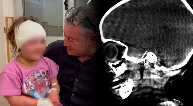 Extraen una aguja de dentista del cerebro de una niña de 4 años en Barcelona.