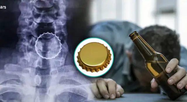 Hombre que bebía cerveza se atoró con una chapa de la botella en Huancavelica.