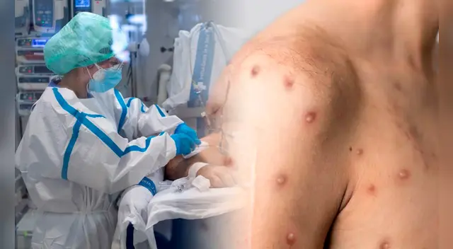 La viruela del mono es una de las enfermedades causada por un virus, según la OMS.