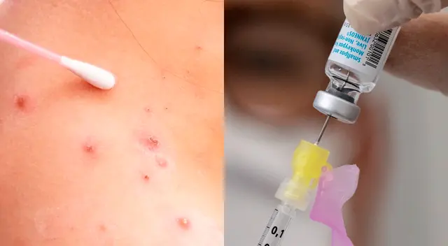 Conoce los aspectos más importantes sobre la viruela del mono. Conoce los aspectos más importantes sobre la viruela del mono.