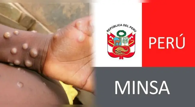 Minsa declaró alerta epidemiológica a largo del país por viruela del mono. Minsa declaró alerta epidemiológica a largo del país por viruela del mono.