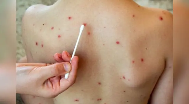 Hay que estar atentos a síntomas como fiebre, erupciones cutáneas, dolor muscular o fatiga.