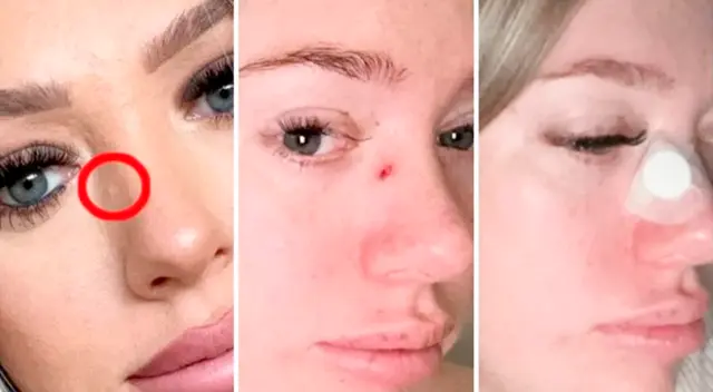 Pensó que tenía un poro obstruido en la nariz y le diagnosticaron cáncer Pensó que tenía un poro obstruido en la nariz y le diagnosticaron cáncer