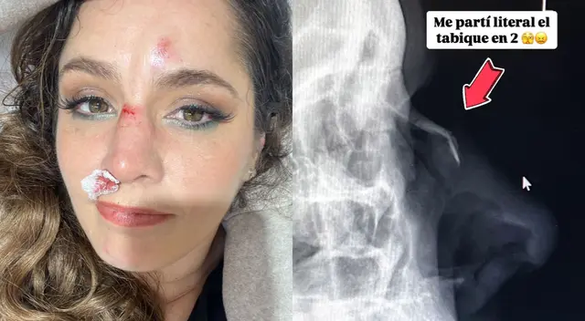 Yiddá Eslava preocupó a sus seguidores al sufrir una terrible lesión en su rostro. Yiddá Eslava preocupó a sus seguidores al sufrir una terrible lesión en su rostro.