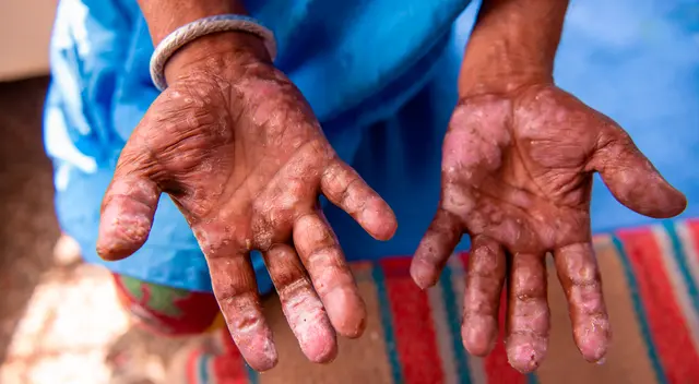 Digesa Piura confirma el primer caso de lepra en este 2025.