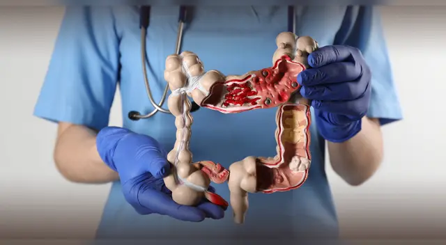 Examen en heces y colonoscopia disminuyen mortalidad casi en su totalidad.