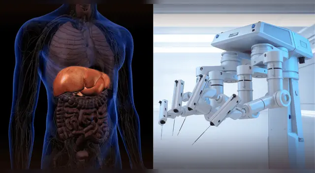 ChatGPT asiste en su primera operación robótica y realiza extirpación de vesícula exitosamente.