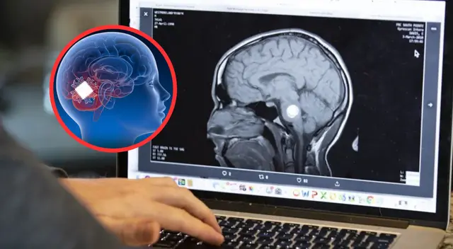 El implante cerebral que apaga la depresión más grave en segundos: conoce la cirugía que está cambiando vidas