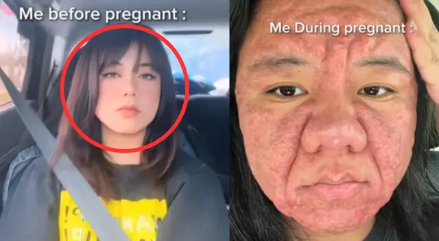 Mujer muestra cómo el embarazo transformó su rostro y destrozó su autoestima