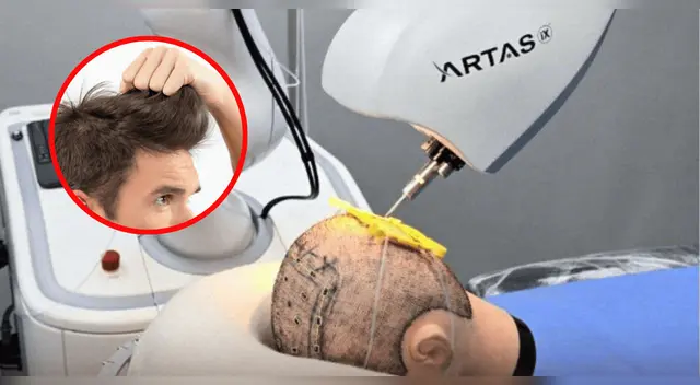 ARTAS iX, el robot que pondrá fin a la calvicie.