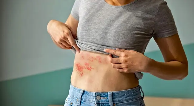 ¿Qué comer para prevenir y aliviar el herpes zóster? Guía nutricional