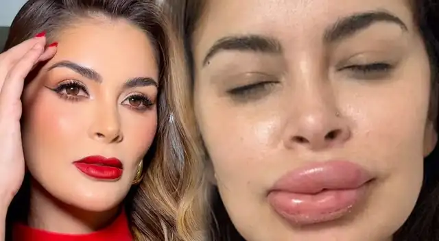 Laura Spoya sufrió reacción alérgica tras tratamiento.