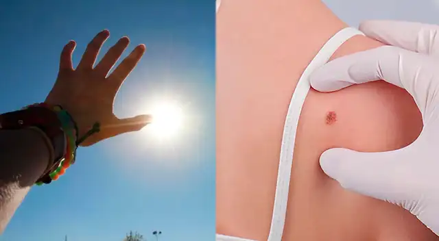 Alerta por radiación UV en el Perú: estas zonas registran mayor riesgo de cáncer de piel, según especialistas del Círculo Dermatológico