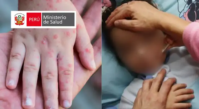 Virus Coxsackie o enfermedad de manos, pies y boca: qué es, cómo se contagia y a quién ataca.