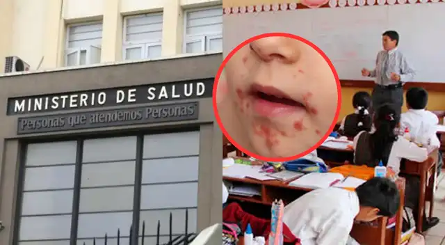 Alerta por Virus Coxsackie: epidemiólogo del Minsa revela el periodo en que crecerían los contagios.
