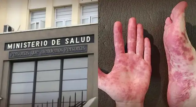 No solo afecta a niños | Minsa revela SÍNTOMA CLAVE del virus Coxsackie que los adultos no deben ignorar.