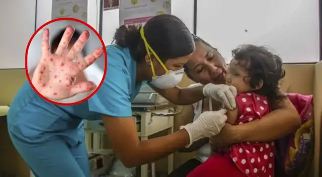 Minsa amplía por 90 días la emergencia sanitaria por el brote de sarampión.