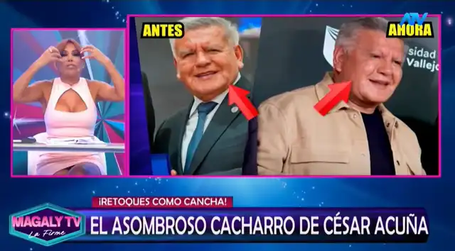 Magaly Medina queda en shock con el NUEVO ROSTRO de César Acuña tras someterse a unos ‘RETOQUITOS’ y lanza polémico comentario: “Le han hecho…” Magaly Medina queda en shock con el NUEVO ROSTRO de César Acuña tras someterse a unos ‘RETOQUITOS’ y lanza polémico comentario: “Le han hecho…”