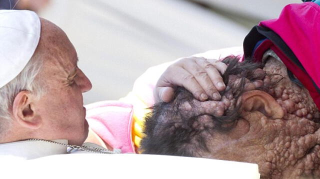 Papa Francisco abraza a hombre con enfermedad en la piel