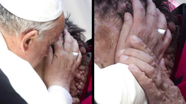 Papa Francisco abraza a hombre con enfermedad en la piel