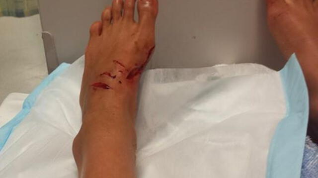 Kirra-Belle Olsson, surfista de 13 años, muestra en Facebook fotos de cómo quedó tras ataque de tiburón
