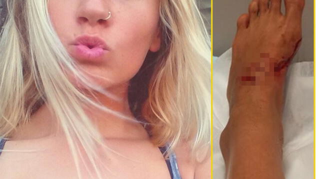 Kirra-Belle Olsson, surfista de 13 años, muestra en Facebook fotos de cómo quedó tras ataque de tiburón