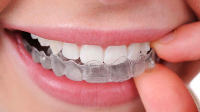 Los protectores dentales ayudan a evitar el desgaste de los dientes 