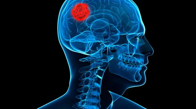 Alerta a tumores cerebrales