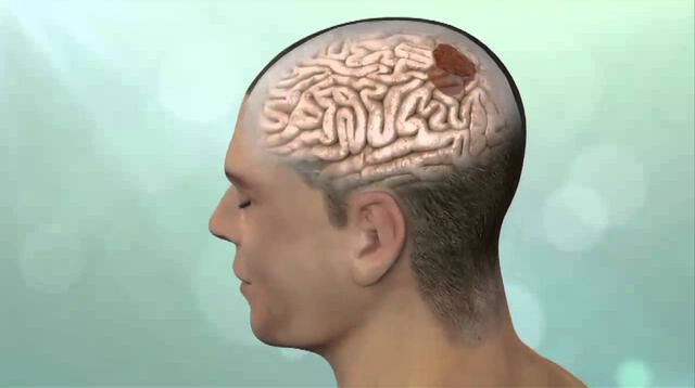 Sintomas de tumores cerebrales aparecen de manera abrupta