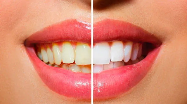 Antes de blanquearte los dientes tienes que tener toda la dentadura sana sin caries