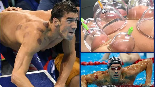Phelps no es el único deportista que realiza esta terapia