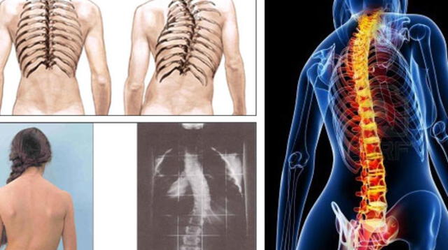 Conoce los signos de alerta de la escoliosis