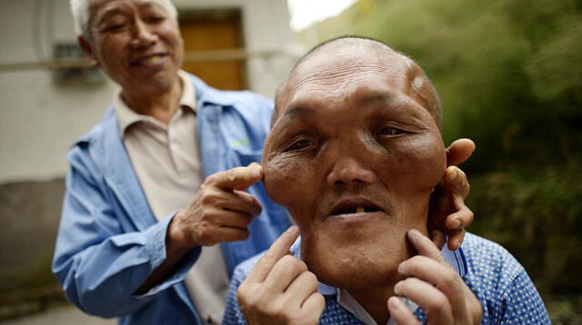 El ciudadano chino sufre de 'hiperplasia facial'