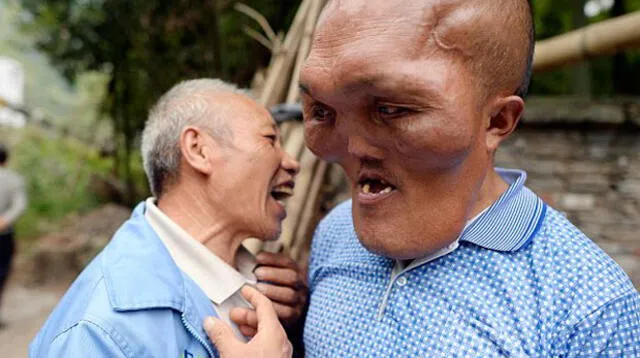 El ciudadano chino sufre de 'hiperplasia facial'