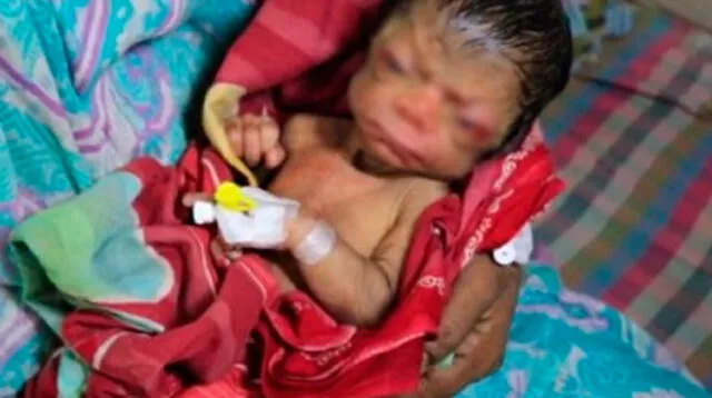 Bebé nace con cara de anciano en Bangladesh 