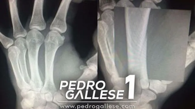 Esta es la radiografía que presentó Pedro Gallese para señalar la gravedad de su lesión.