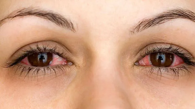  Los principales síntomas son el ojo rojo, lagrimeo, ardor, picazón