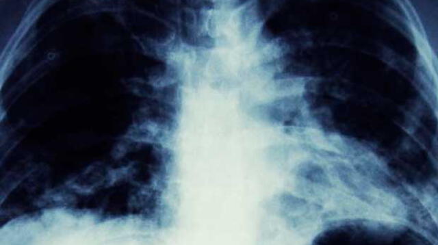 Hombre creía tener cáncer de pulmón, pero los médicos le detectaron algo inesperado