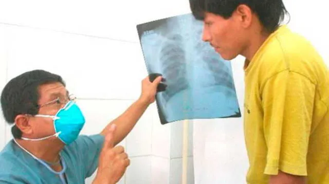 Personas con tuberculosis podrían terminar seriamente afectados sino tratan a tiempo sus males