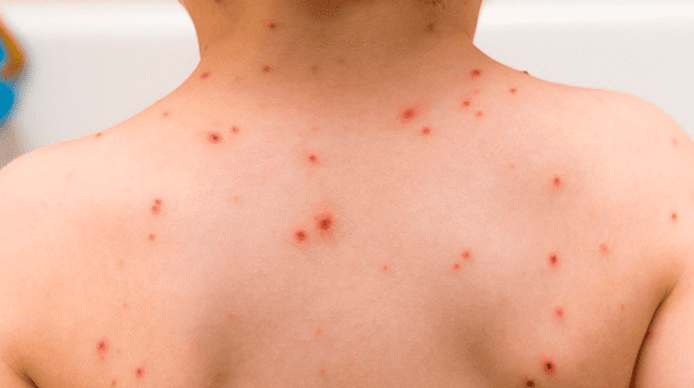 Más de mil niños contrajeron varicela en lo que va del año